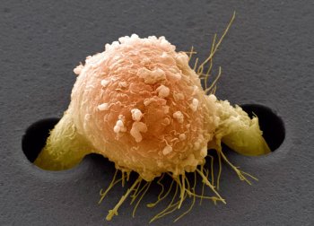 ИИ научился точно определять источник рака по клеткам метастаза — это увеличит выживаемость пациентов